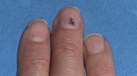 Is melanoma between the toes your major concern? Is That Blood Under My Nail or Is It Melanoma?