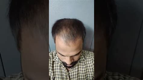 The video focuses on how dermaroller help in hair regrowth and if dermaroller for hair loss: Derma roller || hair growth || part 4.. - YouTube