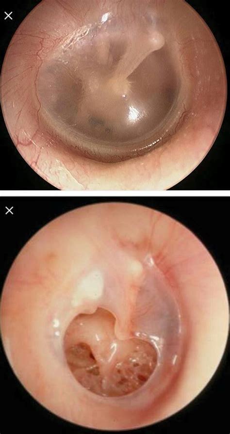 Tinnitus mungkin juga menandakan kerusakan saraf atau masalah pada sistem peredaran darah anda. Gegendang telinga bocor boleh tertutup... - Dr Ezairy M ...