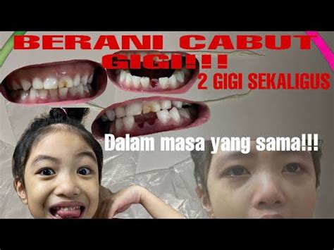 Gigi susu a/ online shop yg menyediakan pakaian muslim anak & dewasa. CABUT GIGI SUSU ANAK! 2 Gigi sekaligus,dalam masa yang ...