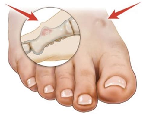 When cancer grows, it can push on nearby organs, nerves, and blood vessels, which can cause signs and symptoms. Bone Tumor of the Foot — Symptoms and Causes