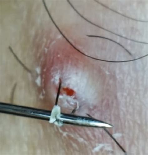 Ingrown hairs on your scalp are annoying, itchy, painful red bumps on top of your head. How to prevent ingrown hair or razor bumps? - LORECENTRAL