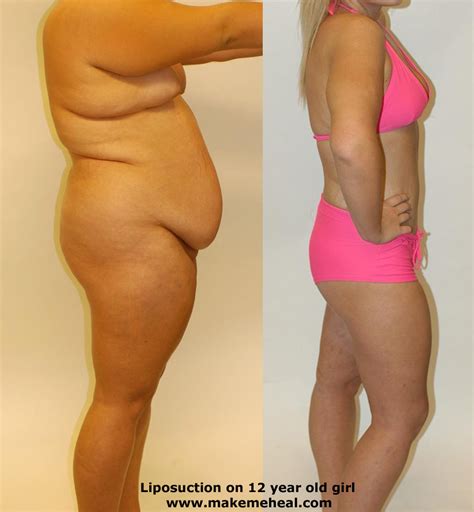 Looking for a liposuction in houston and nearby then visit us. Liposuction Cost : How much and how to evaluate ? ~ The ...