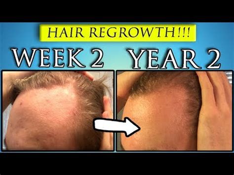 Coconut oil might be exactly what you need. Coconut Oil + Castor Oil Hair Regrowth | YEAR 2 - YouTube