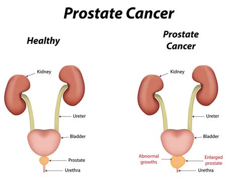 If prostate cancer is suspected based on results of screening tests or symptoms, tests will be needed to be sure. Young Men Also Vulnerable To Prostate Cancer - HealthTimes