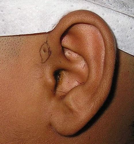 Recurrences are frequent and can be technically challenging. Congenitale preauriculaire cyste (pre-auricular cyst)