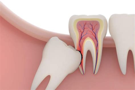 Post operative instructions for after wisdom tooth removal. Wisdom Tooth Removal - Snowflake Family Dental