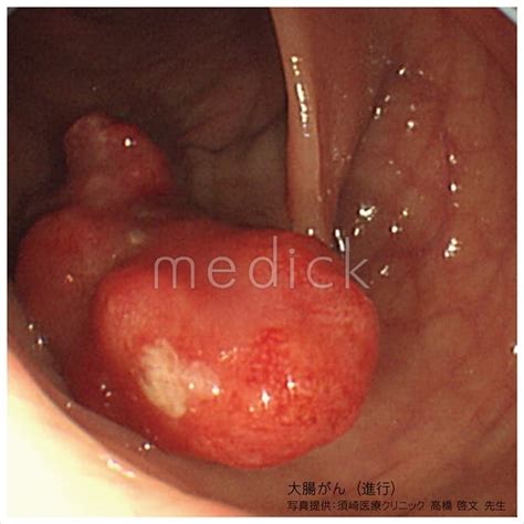 「大腸がん」について正しい情報を知りましょう。 樋口宗孝がん研究基金 munetaka higuchi foundation for cancer awareness and research. 大腸がんの写真 - 医療のイラスト・写真・動画、素材販売 ...