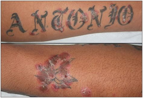 My recommendation to people with psoriasis who want tattoos is…. The Koebner phenomenon: psoriasis in tattoos | CMAJ