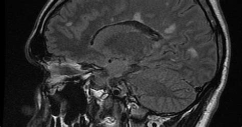 We did not find results for: Esclerosis-Multiple-MSblog: Utilidad de la MRI en el ...