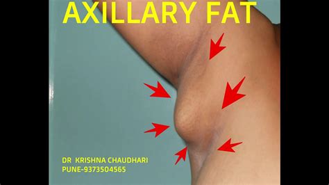 With everything that's said especially when it comes to one of those problematic areas for many women is below the underarm and around the side of the breast that tends find out how to stop emf damage to your physical and mental health. #AXILLARY FAT PAD# liposuction - YouTube