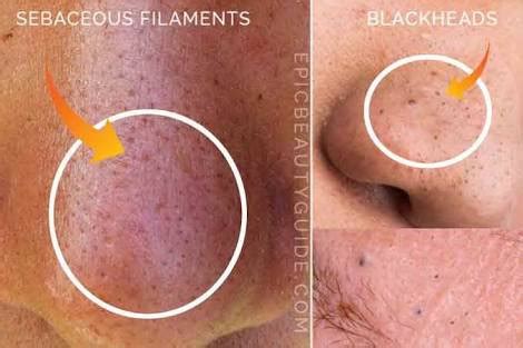 Their formulas offer results that are anything but ordinary. sebaceous filament