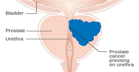 Prostate cancer is one of the most common cancers in the uk, with more than 40,000 new cases diagnosed every year. LA SOLIDARIDAD: 10 Warning Signs Of Prostate Cancer Men ...