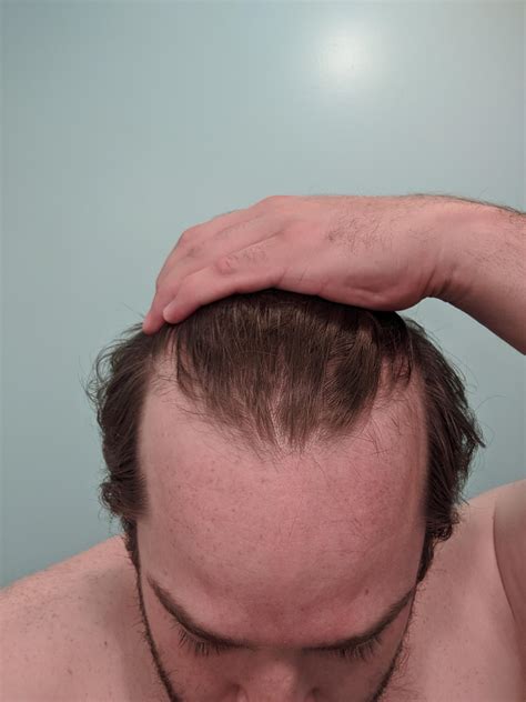 Normal hair loss is highly individual. Just turned 27 recently and have noticed some hair falling ...