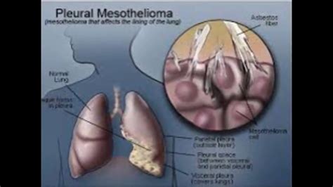 Search faster, better & smarter! 34 mesothelioma survival rates - YouTube