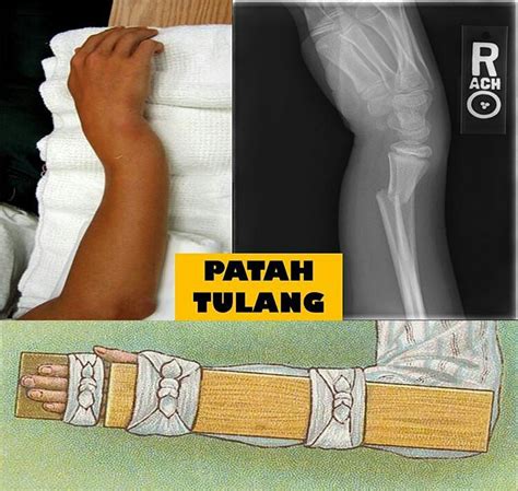 Patah tulang betis dan tulang kering, tepatnya di atas mata kaki. Mengatasi Patah Tulang Saat Pendakian