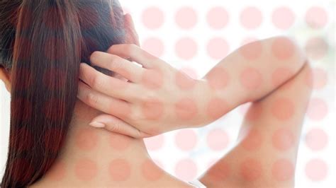 If this happens, you don't need to give up. Don't Scratch It! How To Stop eczema itching at night ...