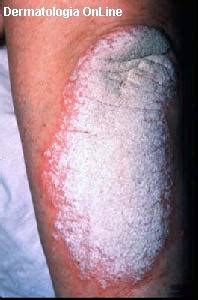 A psoríase é uma doença inflamatória de pele, mediada por células t, hereditária, que sofre influência ambiental. PSORÍASE NÃO É CONTAGIOSA ! ALEGRIA É