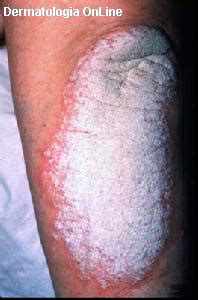 Injury to the skin can trigger psoriatic skin changes at that spot, which is known as the koebner phenomenon. PSORÍASE NÃO É CONTAGIOSA ! ALEGRIA É