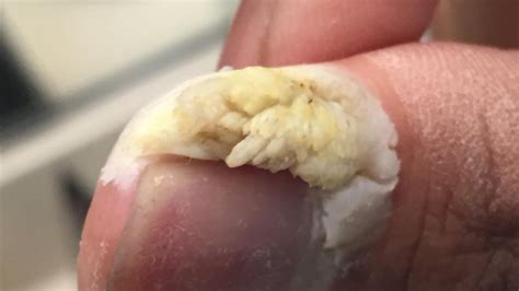 You may notice pus inside the bumps. What Is It? Cyst, Wart, Ingrown Hair, Infected Boil? - YouTube