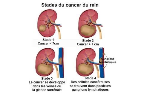 Il s'agit du neuvième cancer en termes de fréquence, de par le monde, avec plus de 330 000 nouveaux cas en 2012. Cancer du rein et traitement des métastases