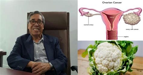 Ovarian cyst terletak di dalam ovari seorang wanita dan kebiasaannya lewat untuk dapat dikesan kewujudannya. Senarai Makanan Ini Bantu Kecutkan Cyst & Fibroid Pada ...