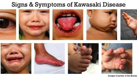 Tanda dan gejala penyakit kawasaki biasanya muncul secara bertahap. Penyakit Kawasaki Membahayakan Kanak-Kanak! | KelabMama ...