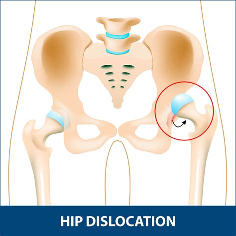 This article will cover hip dislocation, including possible causes and treatments. Hip Dislocation Information | Florida Orthopaedic Institute