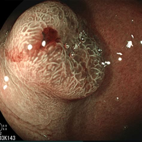 What are the mechanisms that serve to protect the. Gastric cancer imaged with BLI for visualization of the ...