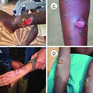 (PDF) Integrated Control and Management of Neglected Tropical Skin Diseases