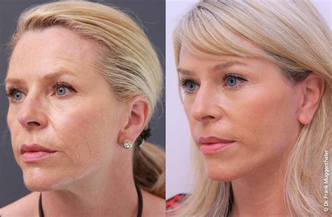 Hyaluronsäure kapseln helfen nicht nur bei der. Vorher Nachher Bilder Facelift, Phenol Peeling ...