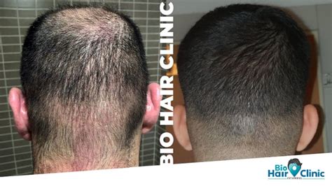 Außerdem, wie schnell wachsen die haare? Haartransplantation Spenderbereich - Wann wachsen die ...