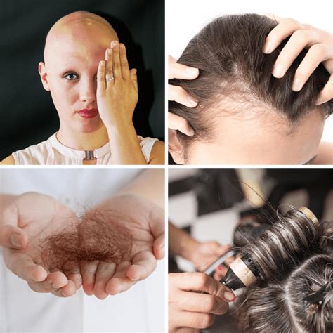 Female hair loss & pattern baldness. Female Pattern Hair Loss Facts: Three Treatments to Combat ...