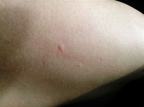 Como identificar a picada do mosquito da dengue
