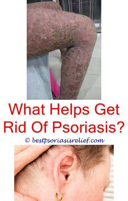 Pin on Eczema Diet