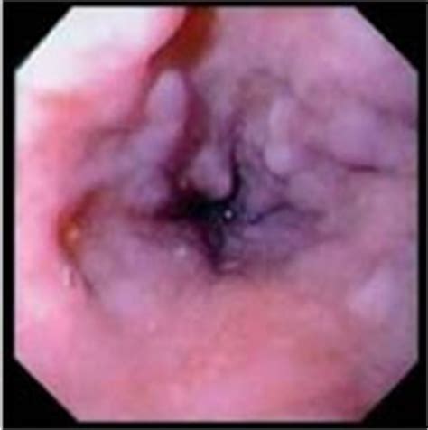 Bei ihnen sind varizen diagnostiziert worden oder sie vermuten dies als diagnose. Hepatitis & More - 2011/1 - Tilman Sauerbruch, Bonn ...