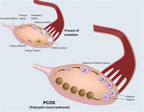 When you have pcos, your reproductive hormones are out of balance. PCOS (polycystic ovary syndrome) laboratory test package ...