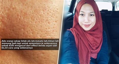 .dengan produk (6.15mb) dan streaming kumpulan lagu cara hilangkan sunburn dan kecilkan pori dengan produk (6.15mb) mp3 terbaru di metrolagu untuk melihat detail lagu cara hilangkan sunburn dan kecilkan pori dengan produk klik salah satu judul yang cocok, kemudian untuk link. Stress Liang Pori Macam Kulit Limau? Gadis Ini Kongsi Tips ...