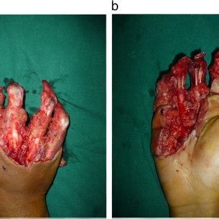 (PDF) The use of pedicled abdominal flaps for coverage of acute ...