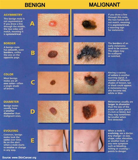 These tumors are usually pale, firm, flat growths that can blend into the normal skin around them. Melanoma Symptoms Abcde - Doctor Heck