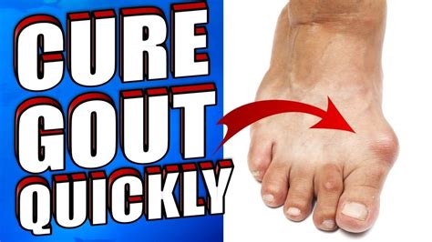 Related:8 bizarre things that swell. How To Get Rid of Gout Naturally in 24 HOURS - YouTube ...