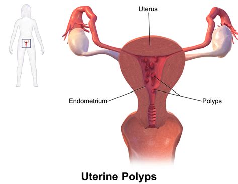 However, it may often start earlier or later. Cervical and Uterus Polyps - Womens Magazine: Advice for ...