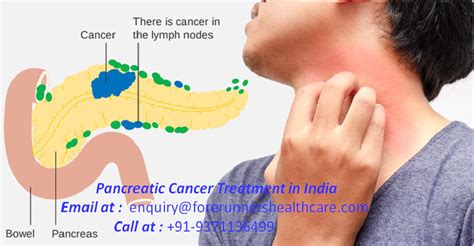 Can pancreatic cancer be detected in a blood test? Treating Pancreatic Cancer: What Are the Success Rate in ...