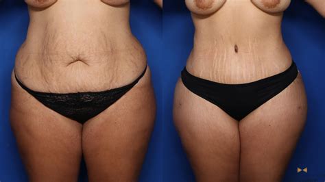 How to lay down after a tummy tuck and bbl. Tummy Tuck Before & After Photos Patient 382 | Fort Worth ...