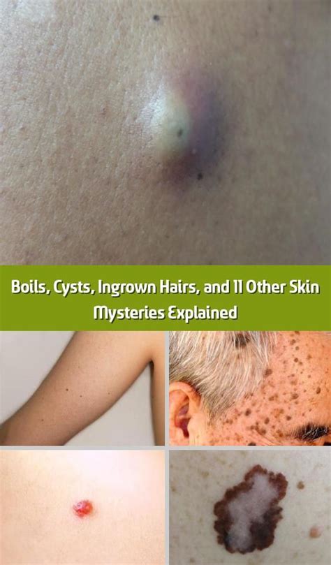 Can an ingrown hair become infected really? Pin auf Skin