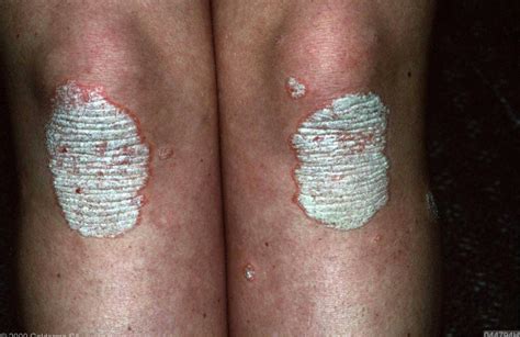 Od ukupno 122 pacijenta, 62,3% njih je imalo psoriasis pustulosa palmoplantaris ; Psoriasis - Alles wat u moet weten over Psoriasis ...