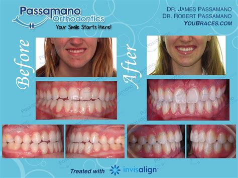 In rare and extreme cases, such as an extreme overbite or underbite, an operation may be necessary. Pin on Invisalign Smile Transformations