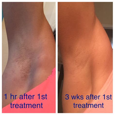 Thus, it is better to avoid any activity that may incur more skin irritation. My Experience (thus far) with Laser Hair Removal | Mama ...