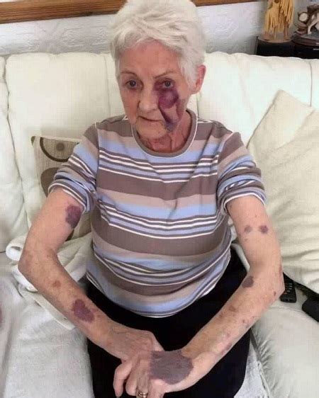 I won't be there in person, so i'd like to send something to commemorate the birthday. 80-year-old Grandmother Gets Beaten Black And Blue at Her ...