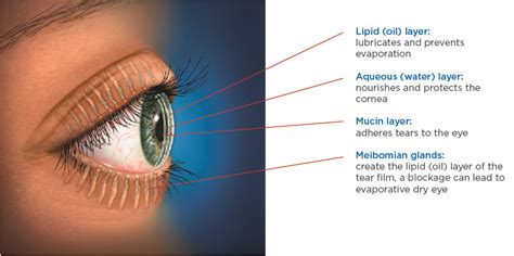 Blurred vision may also occur. Lipiflow Treatments